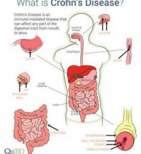 Best strains for Crohn’s Disease